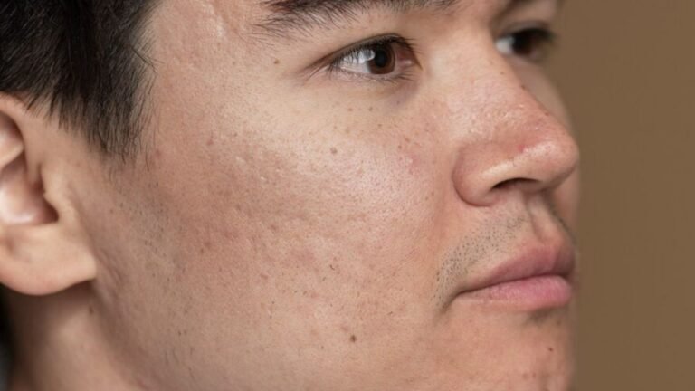 How to Get Rid of Ice Pick Scars: Causes, Prevention, and Treatment